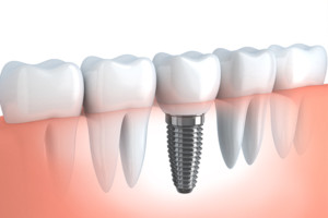 dental-implants-web